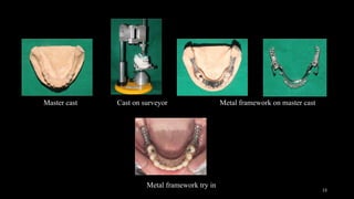 Master Cast Model Altered Cast Technique removable partial denture 3.1.pptx