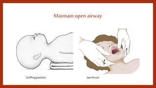 Maintainopen airway
Sniffing position Jaw thrust
 