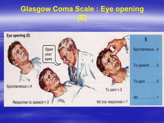 Glasgow Coma Scale : Eye opening
(E)
 