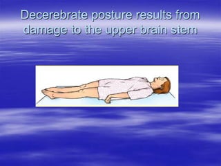 Decerebrate posture results from
damage to the upper brain stem
 