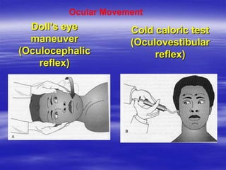 Doll’s eye
maneuver
(Oculocephalic
reflex)
Cold caloric test
(Oculovestibular
reflex)
Ocular Movement
 
