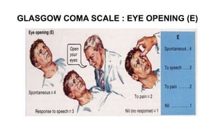 GLASGOW COMA SCALE : EYE OPENING (E)
 