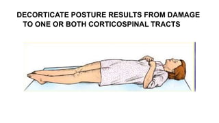 DECORTICATE POSTURE RESULTS FROM DAMAGE
TO ONE OR BOTH CORTICOSPINAL TRACTS
 