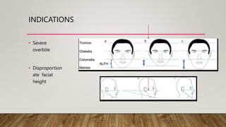 Altering vertical dimension of occlusion.pptx