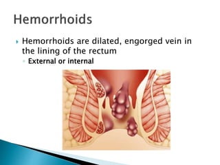  Hemorrhoids are dilated, engorged vein in
the lining of the rectum
◦ External or internal
 