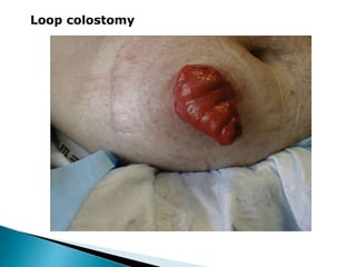 Loop colostomy
 