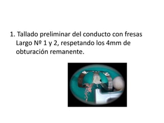 1. Tallado preliminar del conducto con fresas 
Largo Nº 1 y 2, respetando los 4mm de 
obturación remanente. 
 