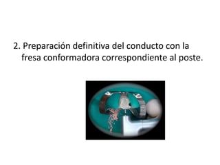 2. Preparación definitiva del conducto con la 
fresa conformadora correspondiente al poste. 
 
