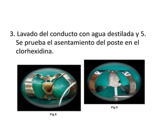 3. Lavado del conducto con agua destilada y 5. 
Se prueba el asentamiento del poste en el 
clorhexidina. 
 