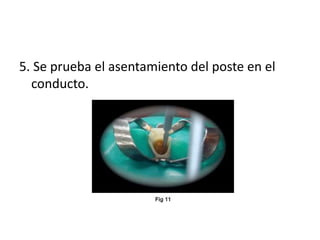 5. Se prueba el asentamiento del poste en el 
conducto. 
 