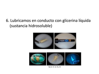 6. Lubricamos en conducto con glicerina líquida 
(sustancia hidrosoluble) 
 