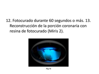 12. Fotocurado durante 60 segundos o más. 13. 
Reconstrucción de la porción coronaria con 
resina de fotocurado (Miris 2). 

