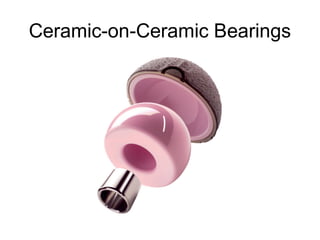 Ceramic-on-Ceramic Bearings
 