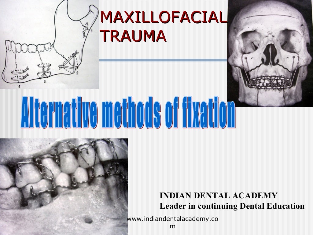 Alternative methods of fixation /dental courses