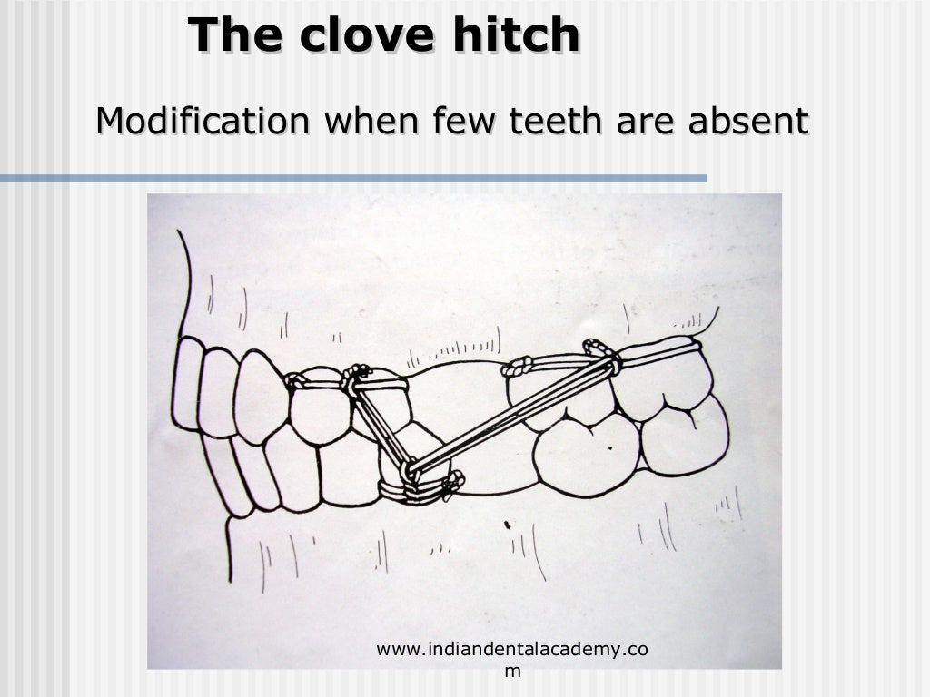 Alternative methods of fixation /dental courses