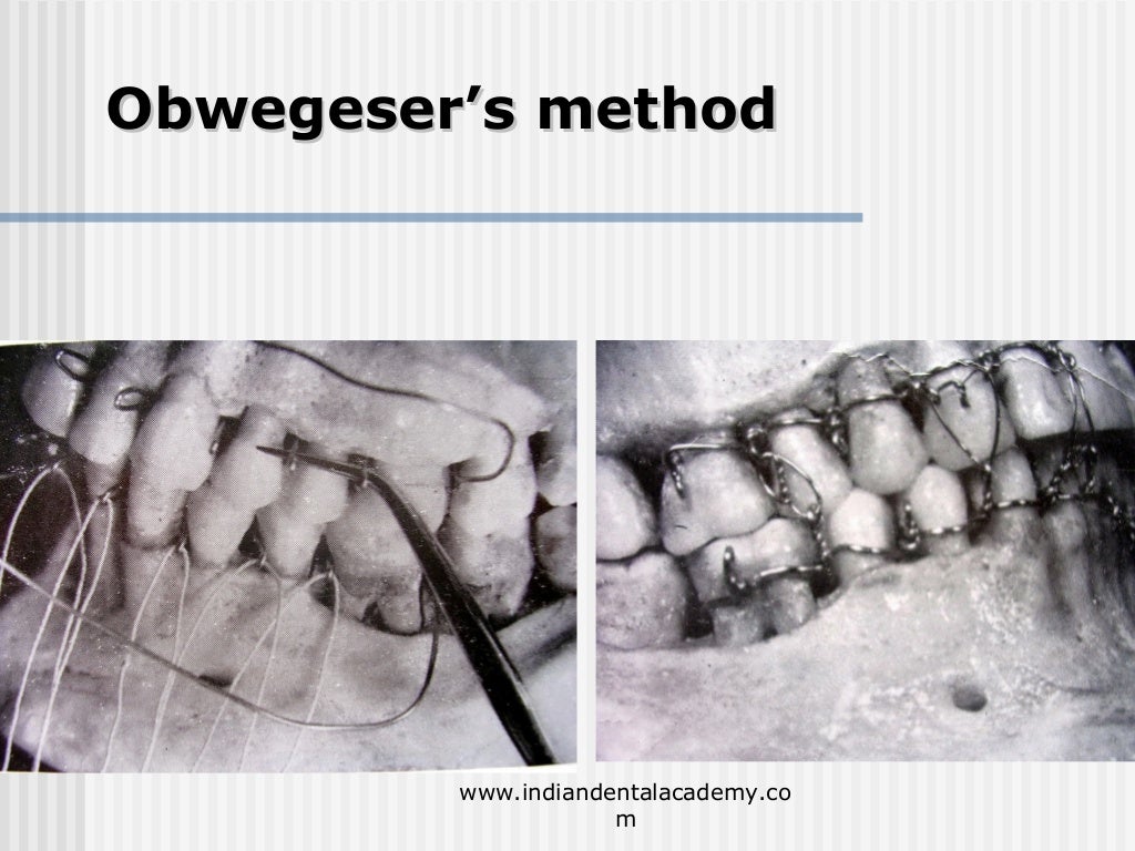 Alternative methods of fixation /dental courses