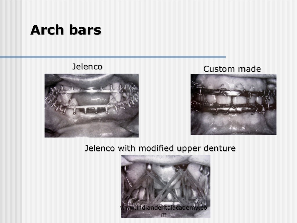Alternative methods of fixation /dental courses