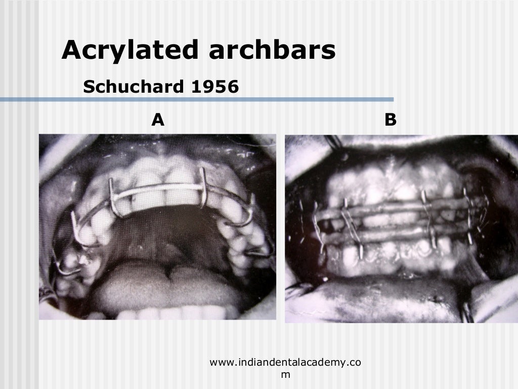 Alternative methods of fixation /dental courses