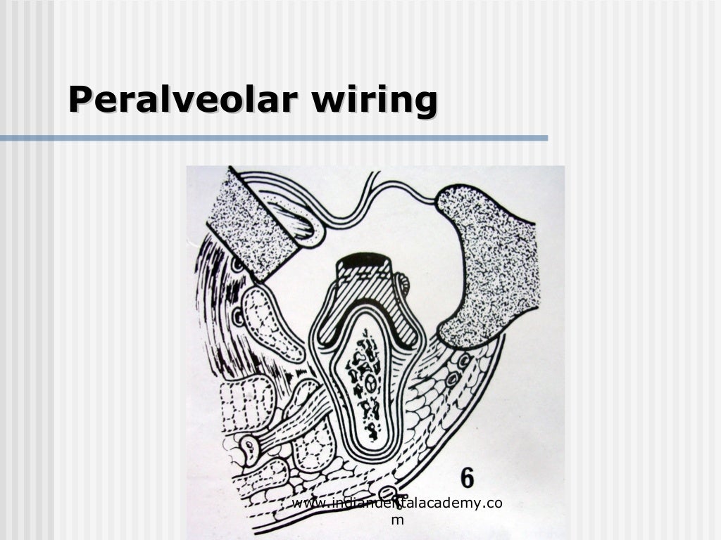 Alternative methods of fixation /dental courses