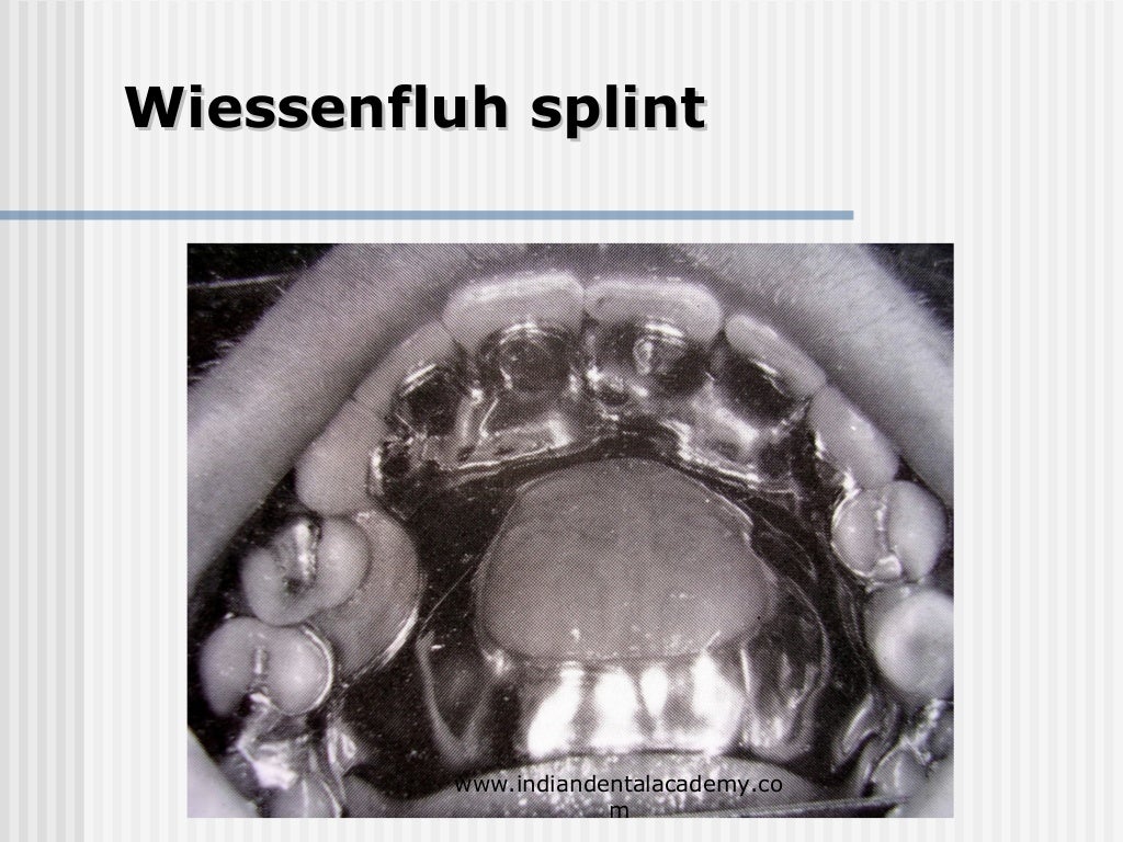Alternative methods of fixation /dental courses