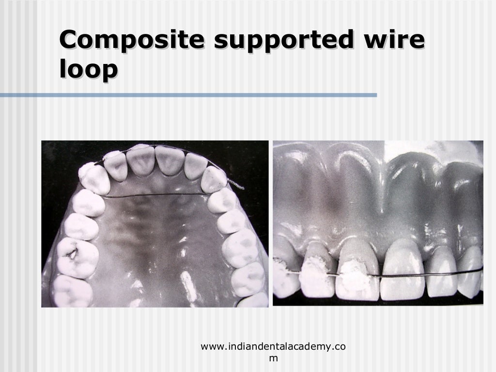 Alternative methods of fixation /dental courses