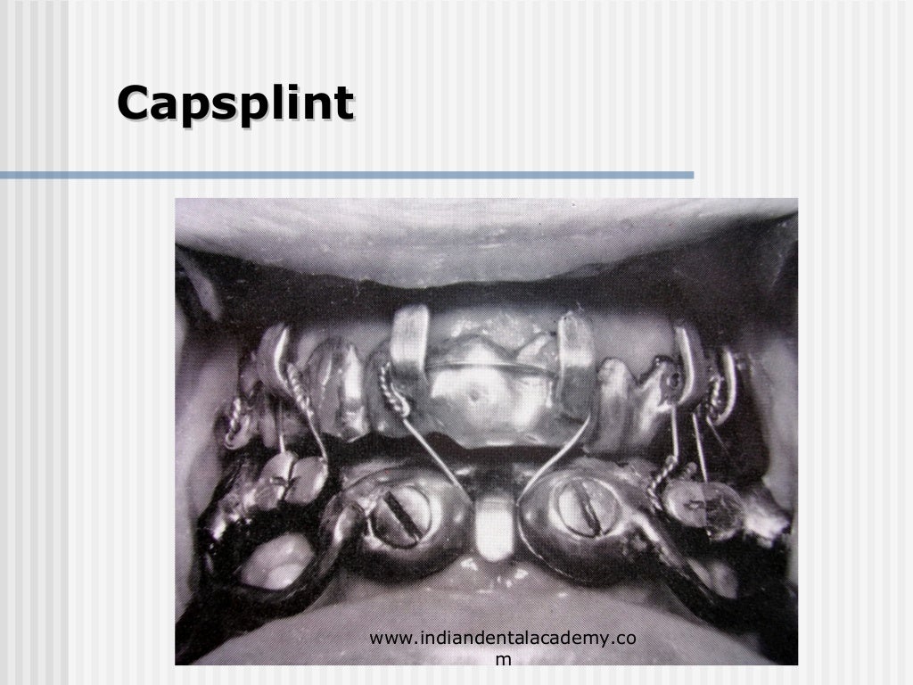 Alternative methods of fixation /dental courses