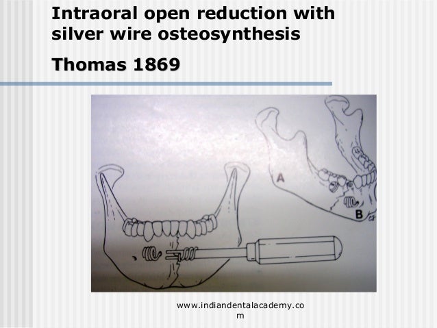 Wire osteosynthesis picture
