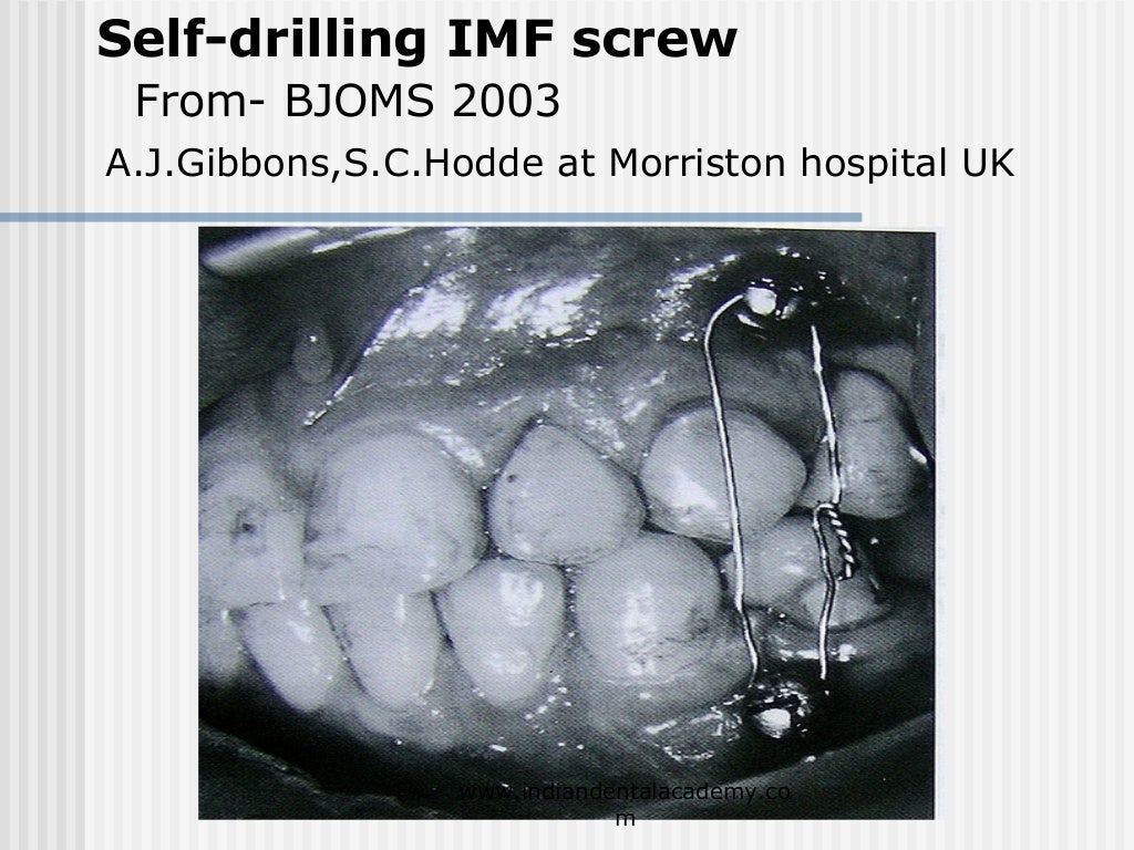 Alternative methods of fixation /dental courses
