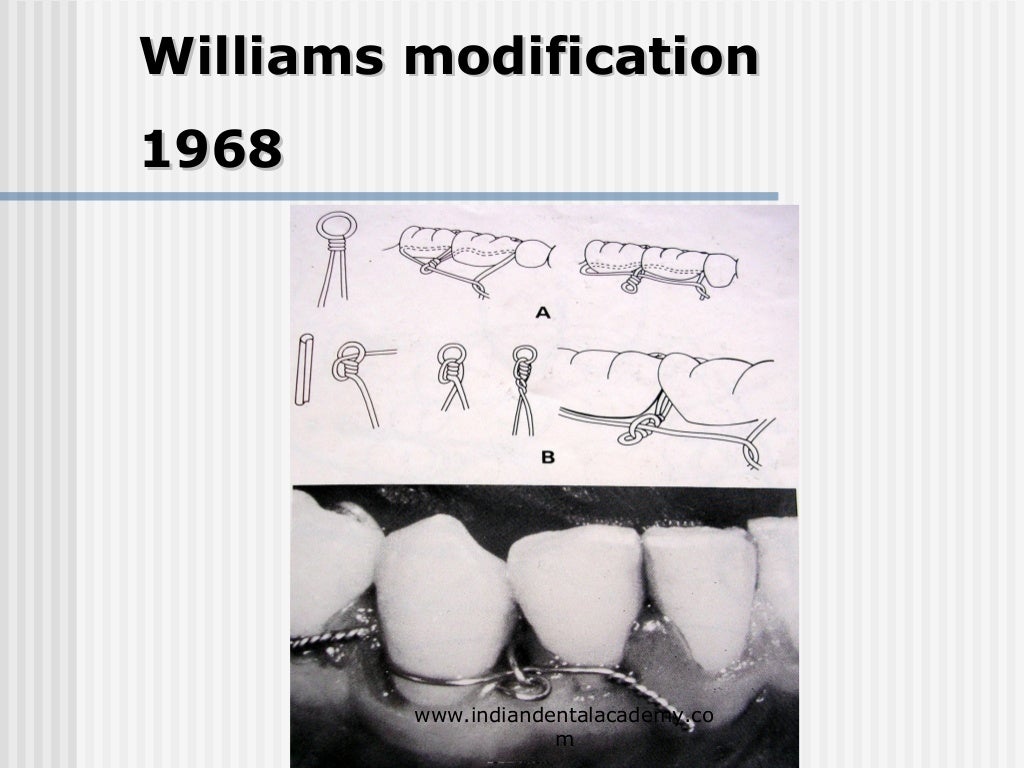 Alternative methods of fixation /dental courses
