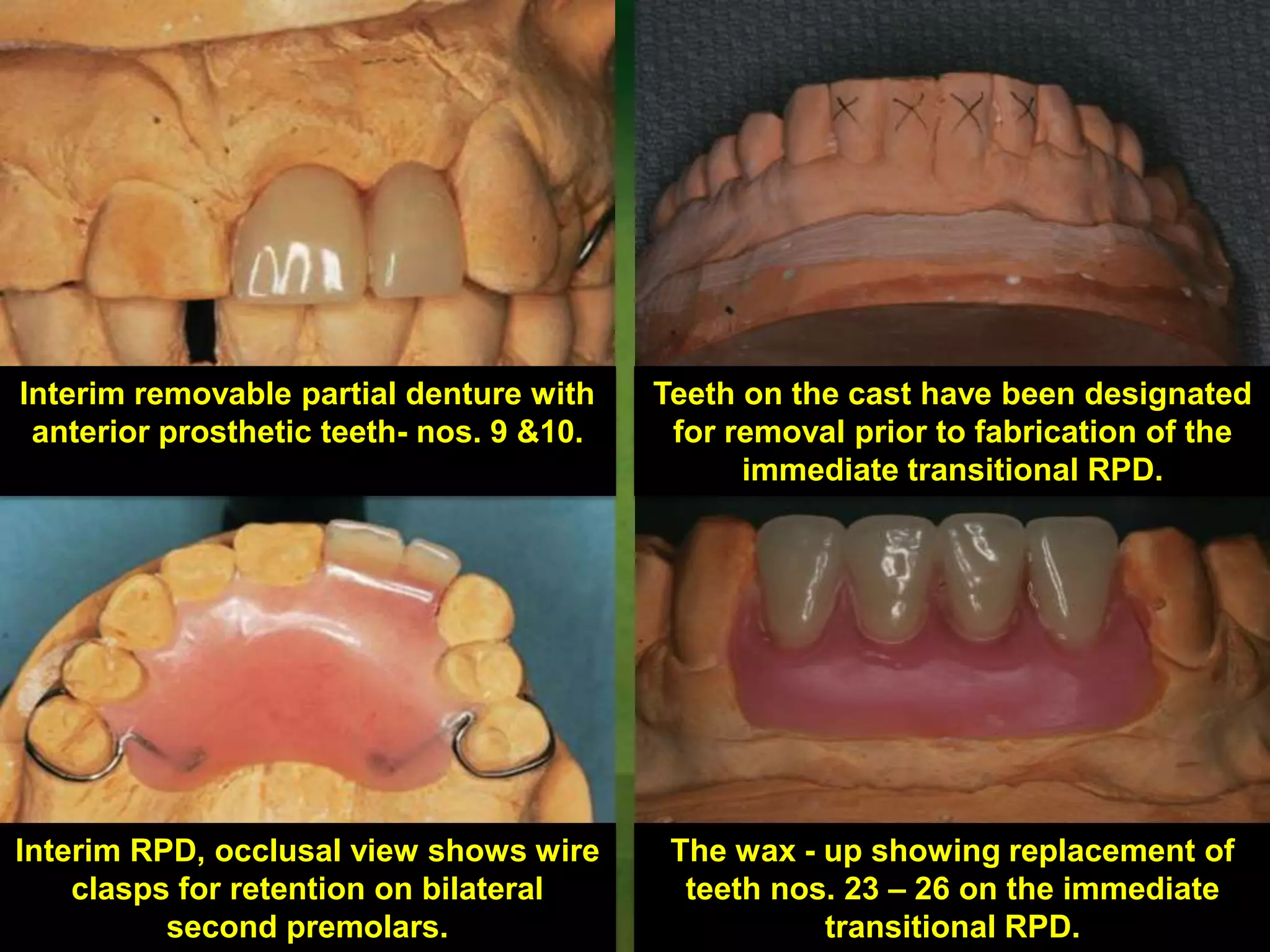 Indication Of Alternative Removable Partial Dentures PPTX