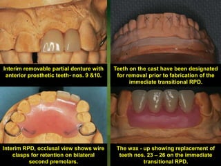 Indication of Alternative removable partial dentures | PPTX