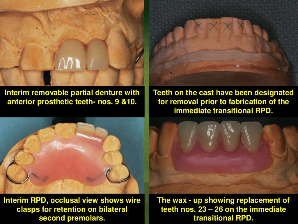 Indication of Alternative removable partial dentures