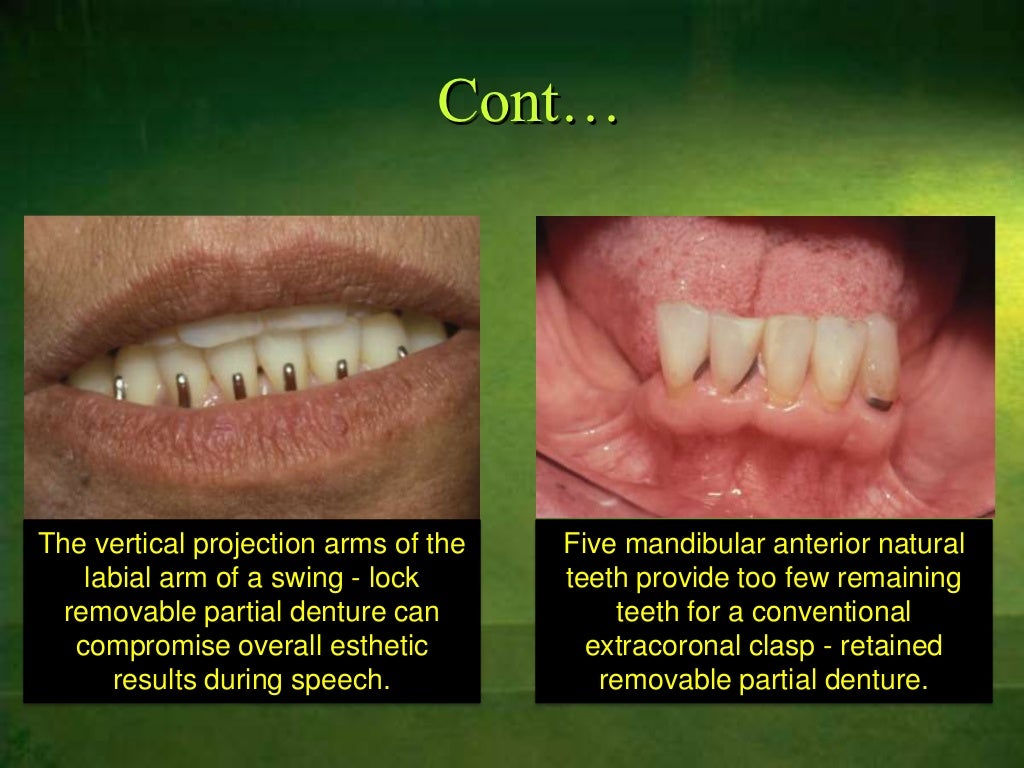 Indication of Alternative removable partial dentures