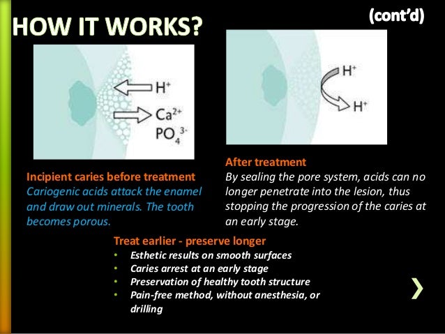 Alternatives to conventional cavity preparation in ...