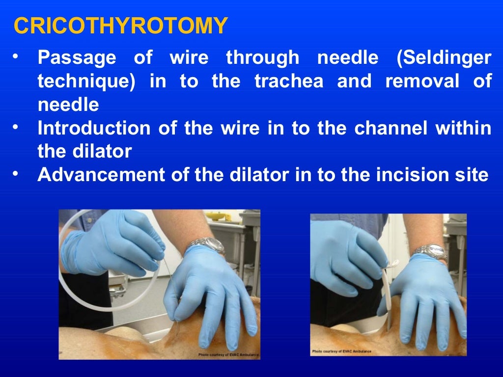 Alternative technique of intubation retromolar, retrograde, submental…