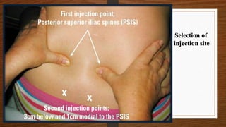 Selection of
injection site
 
