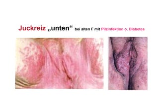 Juckreiz „unten“ bei alten F mit Pilzinfektion o. Diabetes
 