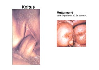Koitus
         Muttermund
         beim Orgasmus 12 St. danach
 