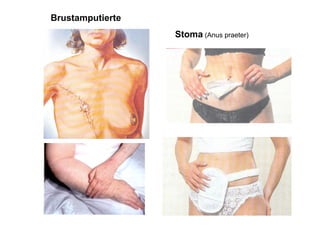 Brustamputierte
                  Stoma (Anus praeter)
 