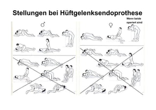 Stellungen bei Hüftgelenksendoprothese
                                 Wenn beide
                                 operiert sind
 