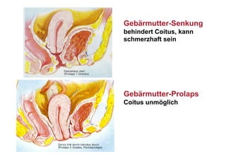Gebärmutter-Senkung
behindert Coitus, kann
schmerzhaft sein




Gebärmutter-Prolaps
Coitus unmöglich
 