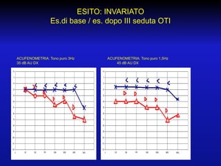 ESITO: INVARIATO
Es.di base / es. dopo III seduta OTI

ACUFENOMETRIA: Tono puro 3Hz
35 dB AU DX

ACUFENOMETRIA: Tono puro 1,5Hz
45 dB AU DX

 