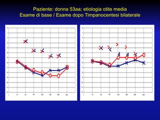 Paziente: donna 53aa; etiologia otite media
Esame di base / Esame dopo Timpanocentesi bilaterale

 
