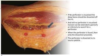 • If No perforator is visualized the
deep fascia should be dissected off
the VL.
• And still no perforator is visualized
incision can be extended superiorly
or inferiorly to search for a
perforator.
• When the perforator is found ,then
only the dissection proceeds.
• The perforator is dissected to its
source pedicle .
 