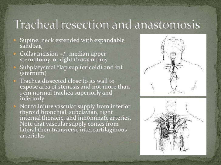 Adult laryngotracheal stenosis