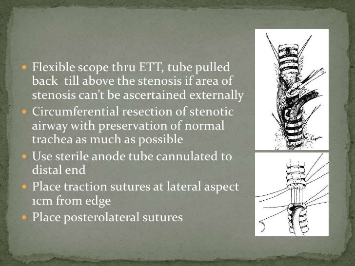 Adult laryngotracheal stenosis