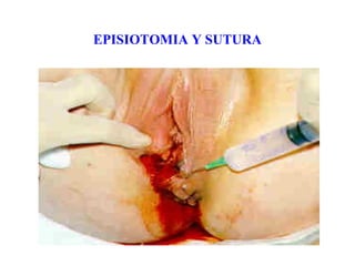 EPISIOTOMIA Y SUTURA
 