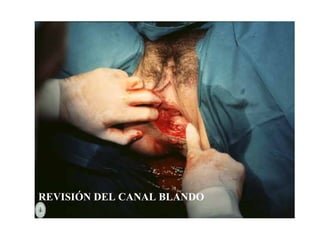 REVISIÓN DEL CANAL BLANDO
 