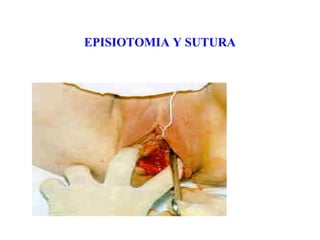 EPISIOTOMIA Y SUTURA
 