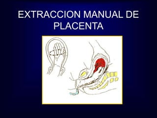 EXTRACCION MANUAL DE 
PLACENTA 
 